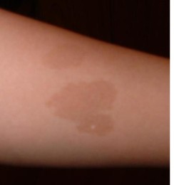 birth marks